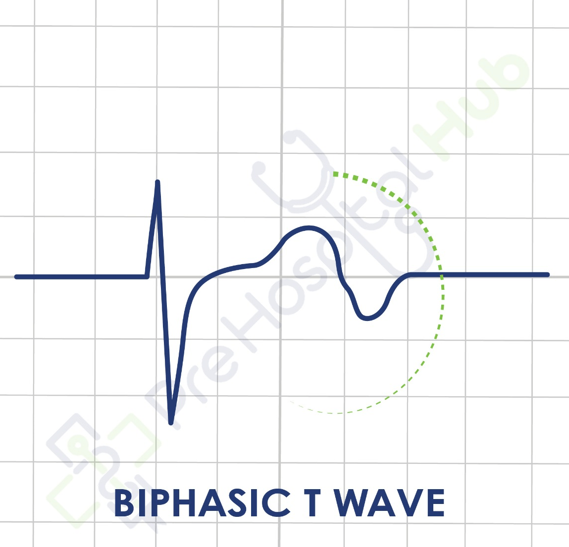 Biphasic T Wave