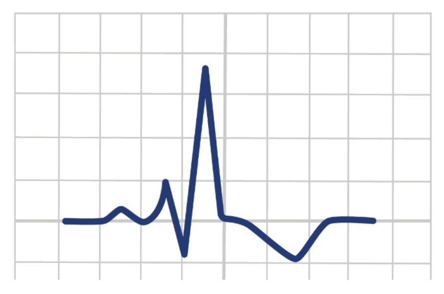 ECG