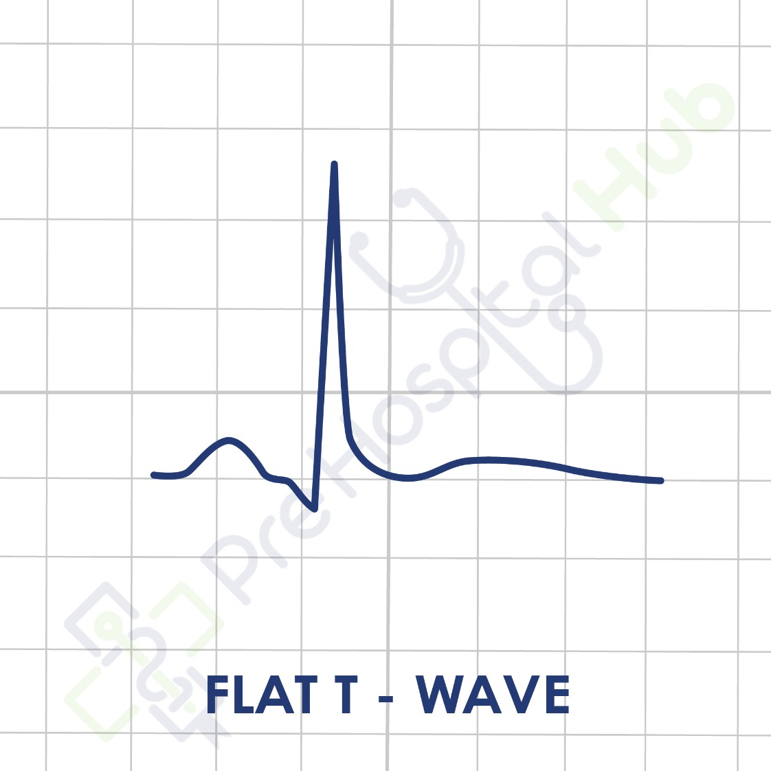 Flat T Wave