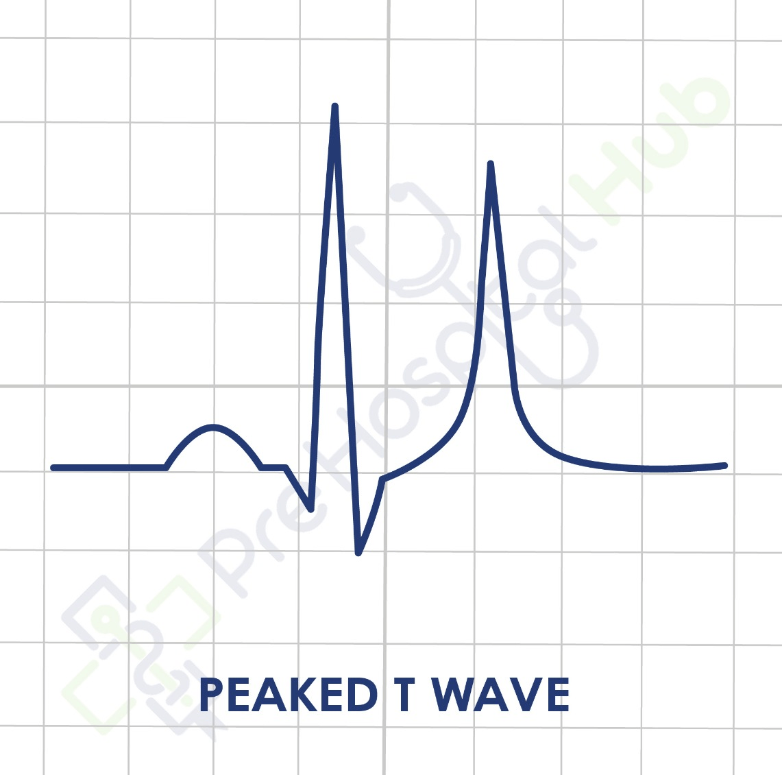 Peaked T Wave