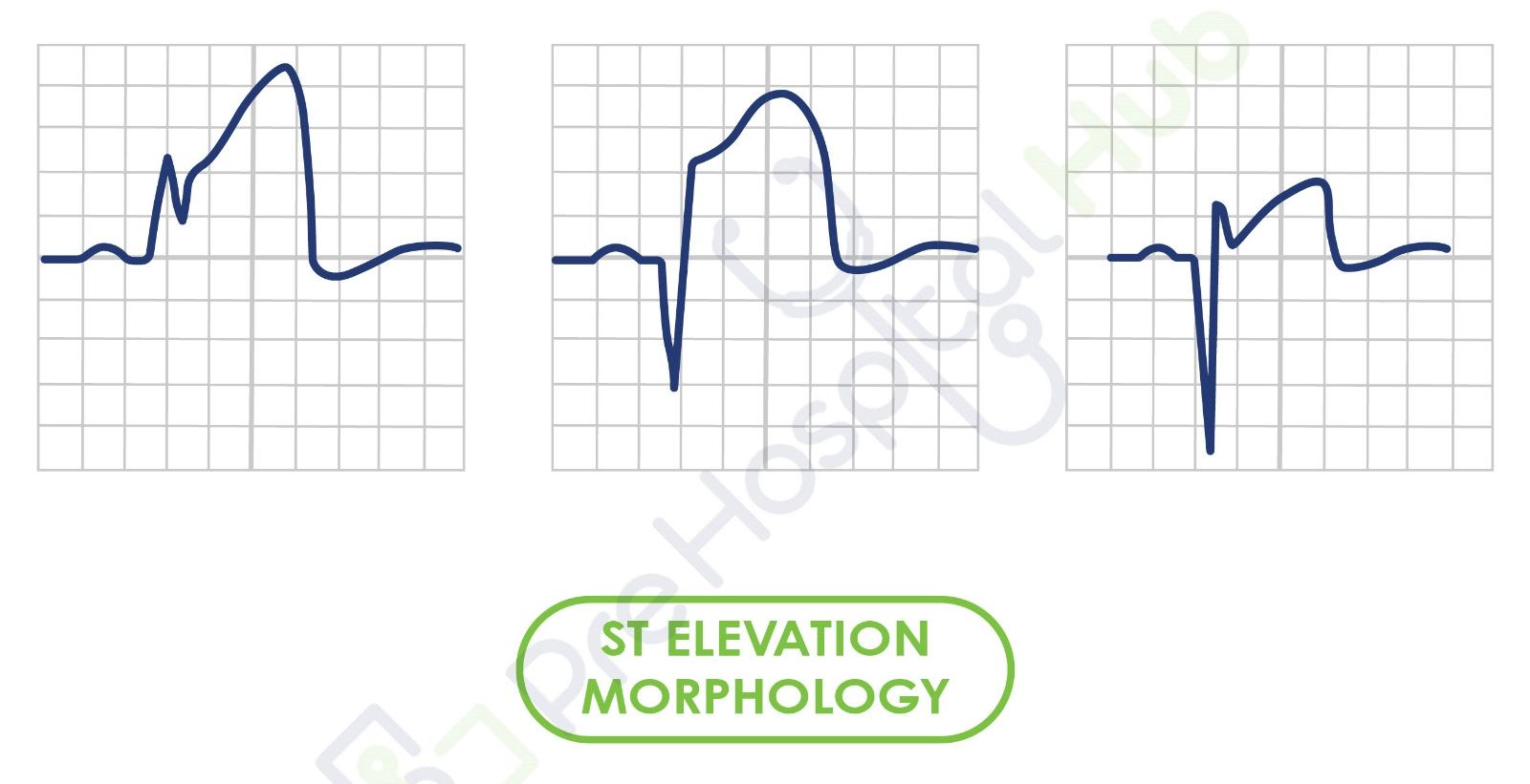 ST Elevation Morphologies