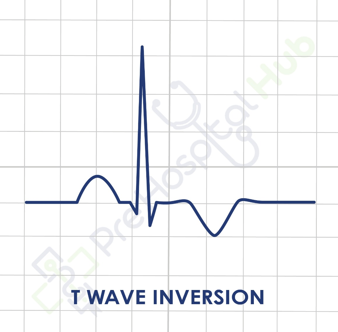 T Wave Inversion