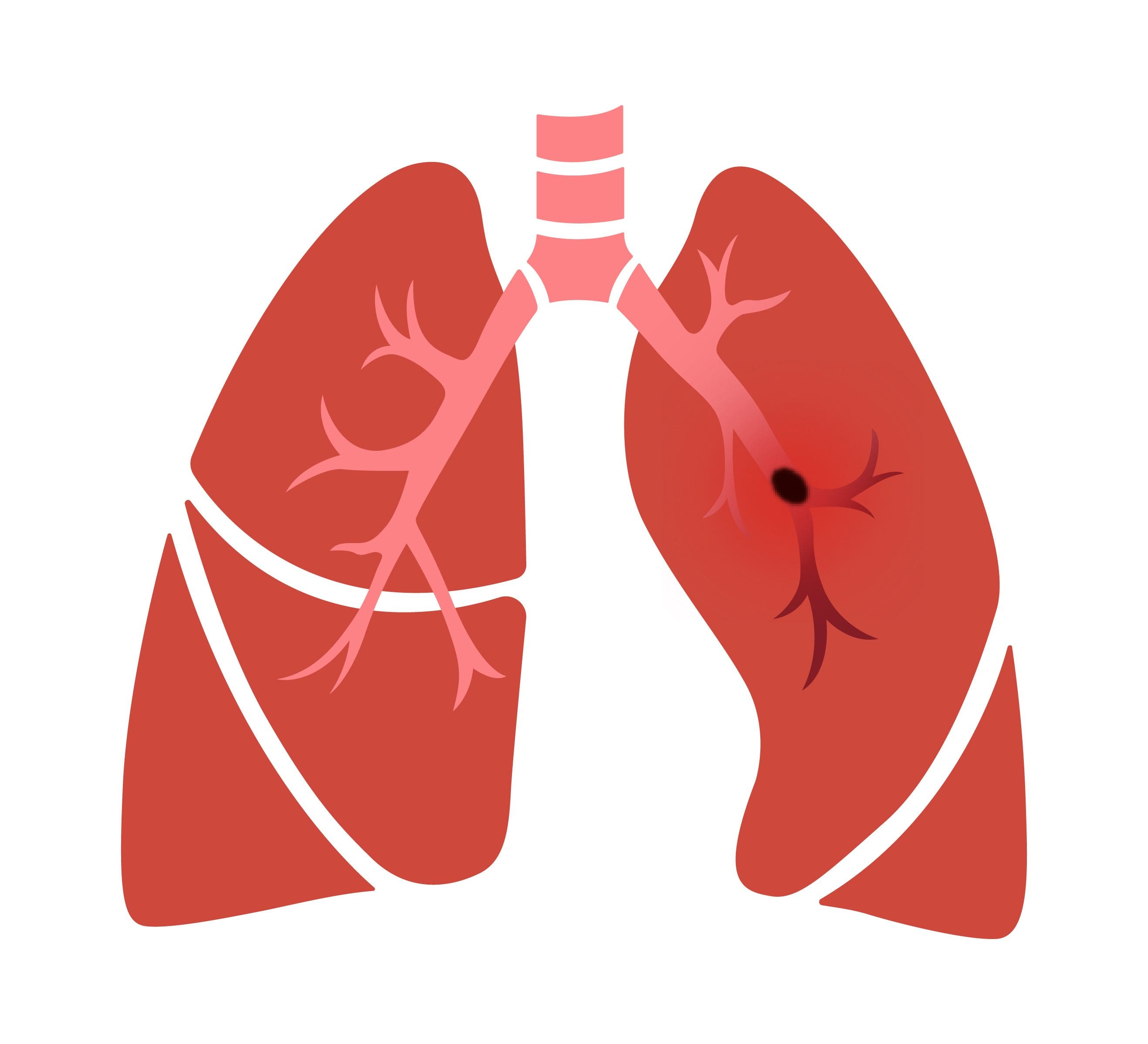 Pulmonary Embolism