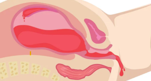 Postpartum Haemorrhage